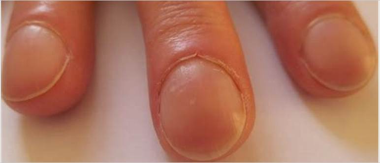 Pictures of nail clubbing